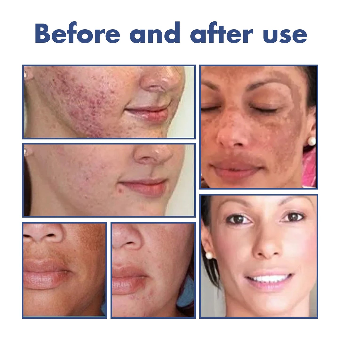 OUHOE Blemish Skin Clarifying Cleansing Lotion Acne Care and Brightening, 50ml