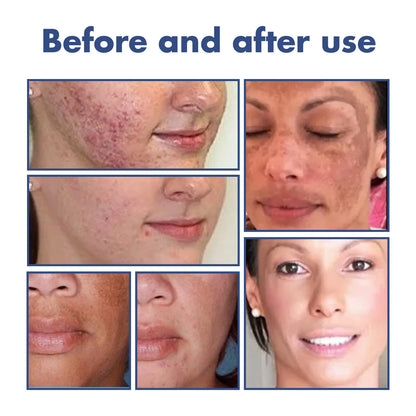 OUHOE Blemish Skin Clarifying Cleansing Lotion Acne Care and Brightening, 50ml