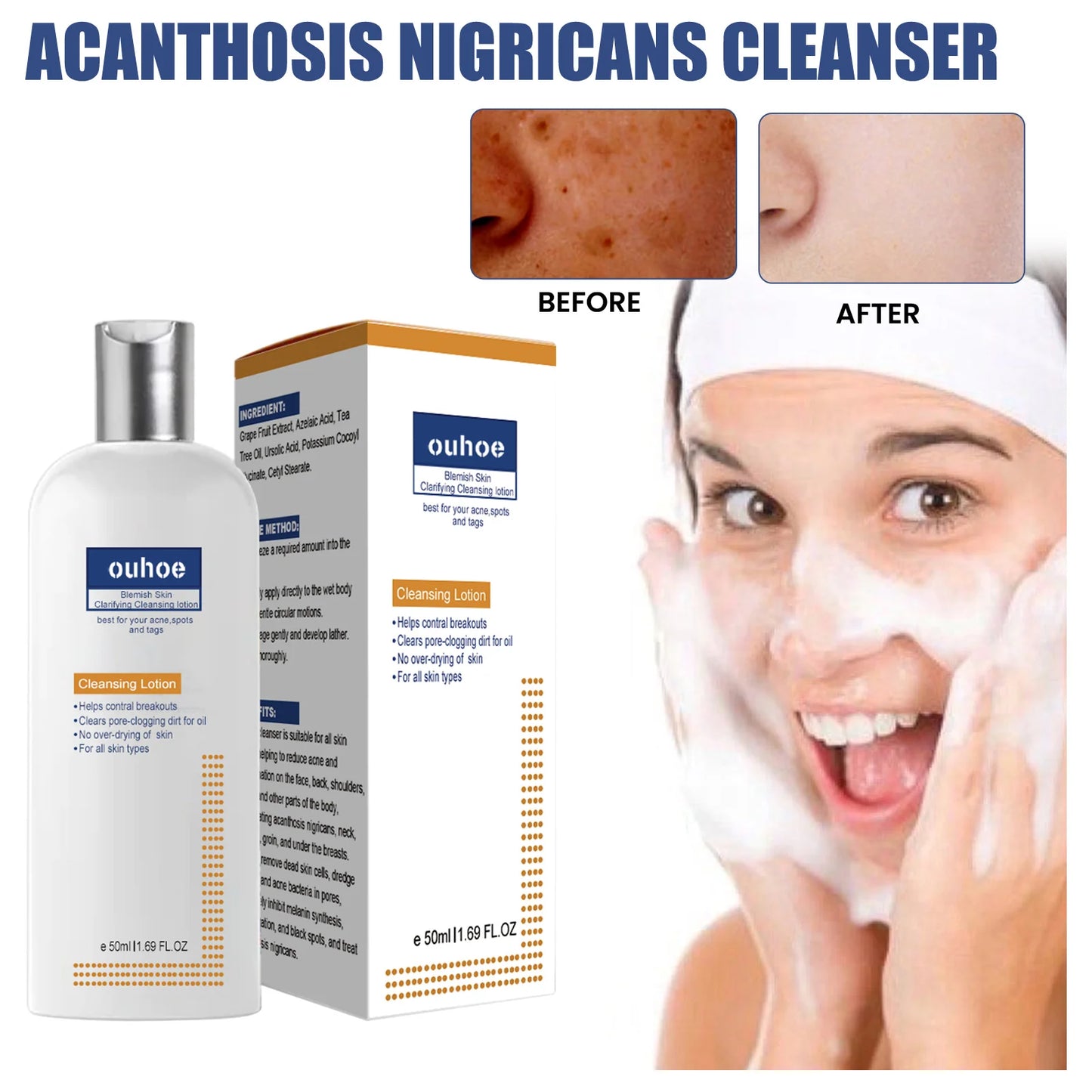OUHOE Blemish Skin Clarifying Cleansing Lotion Acne Care and Brightening, 50ml